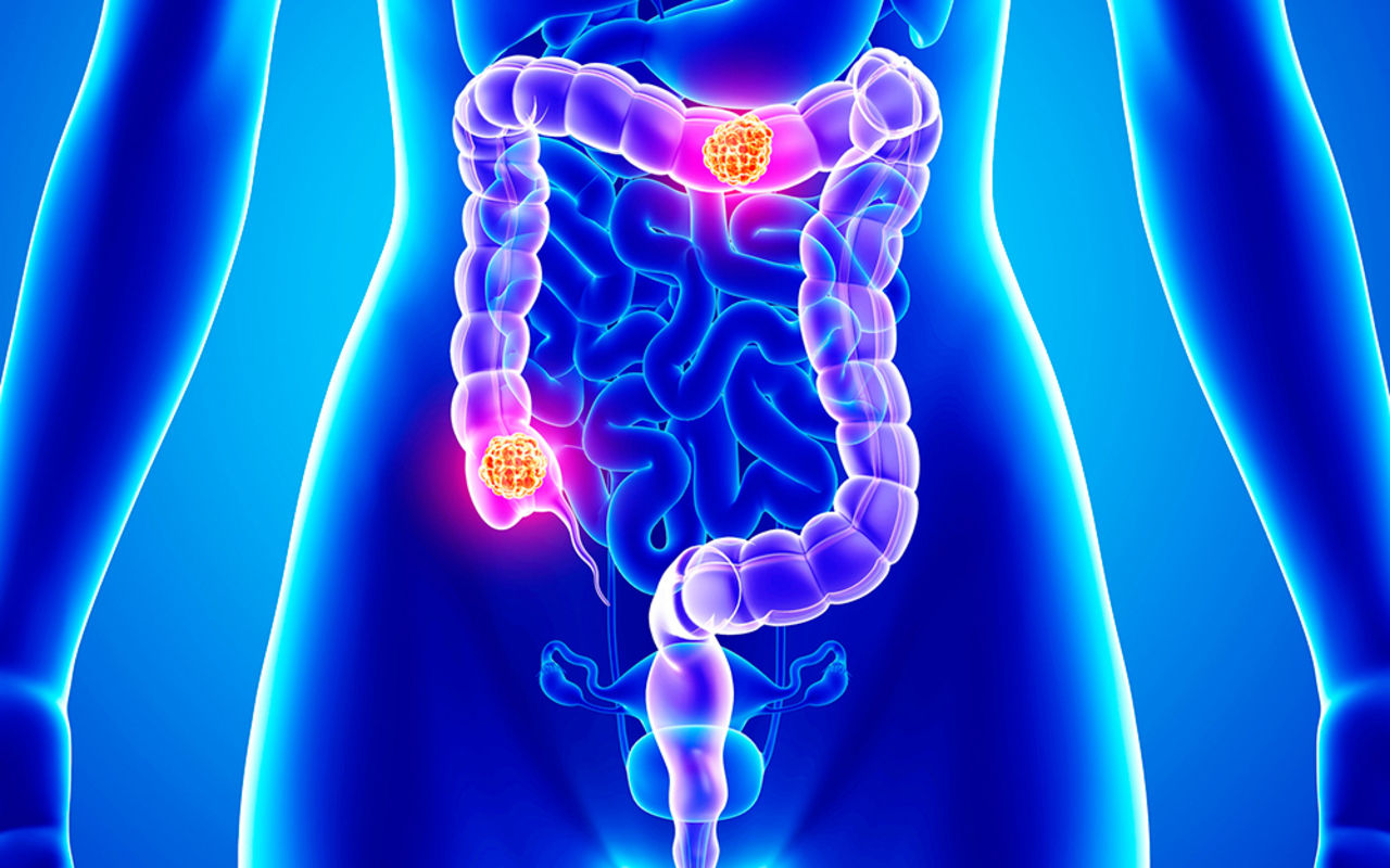 First Stage Colon Cancer: What Are The Signs? | Astro Ulagam