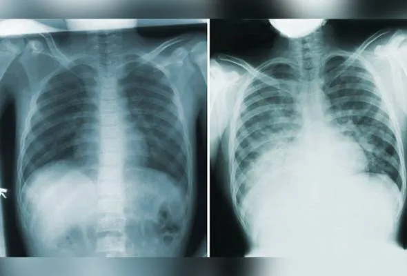 51752364843_pneumonicplague.jpg