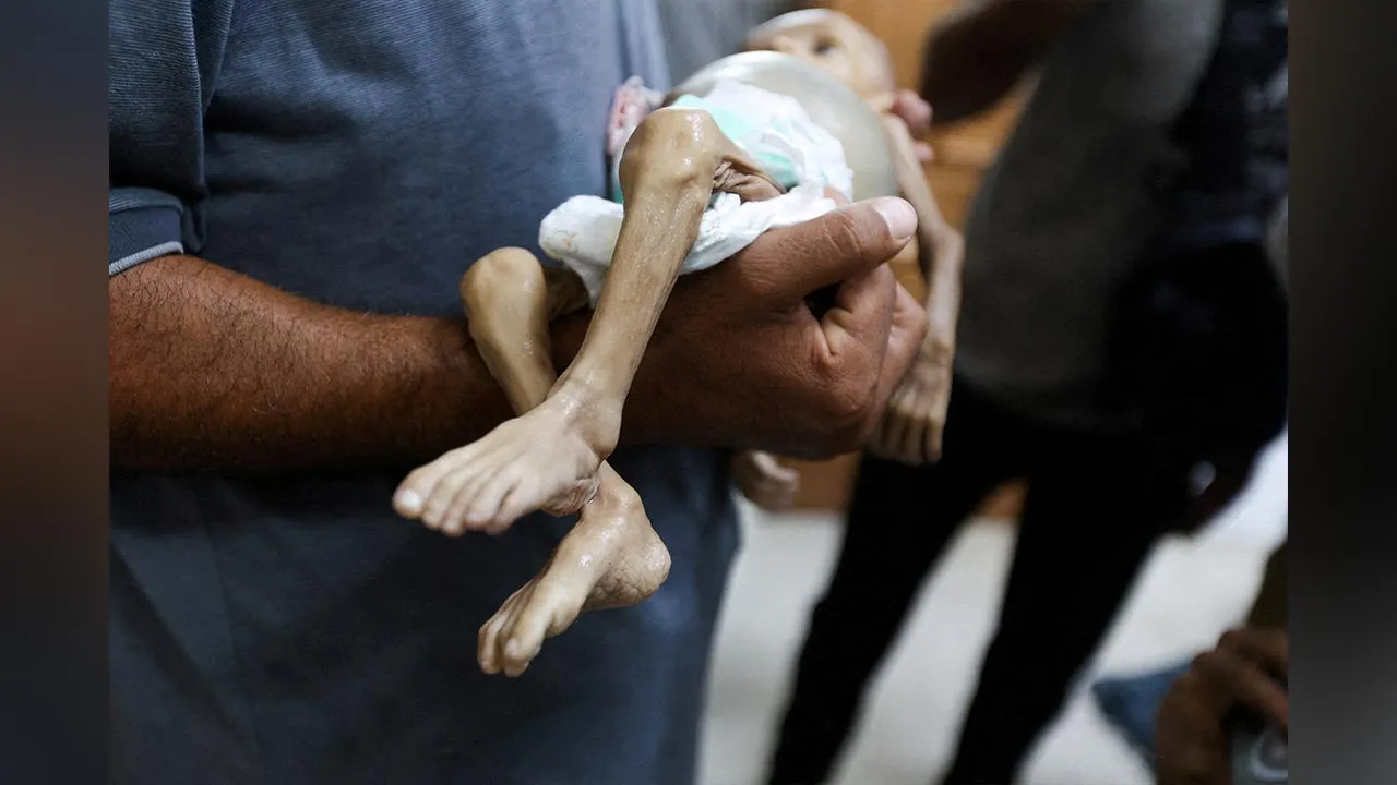 71754177171_TBmalnutrition.jpg