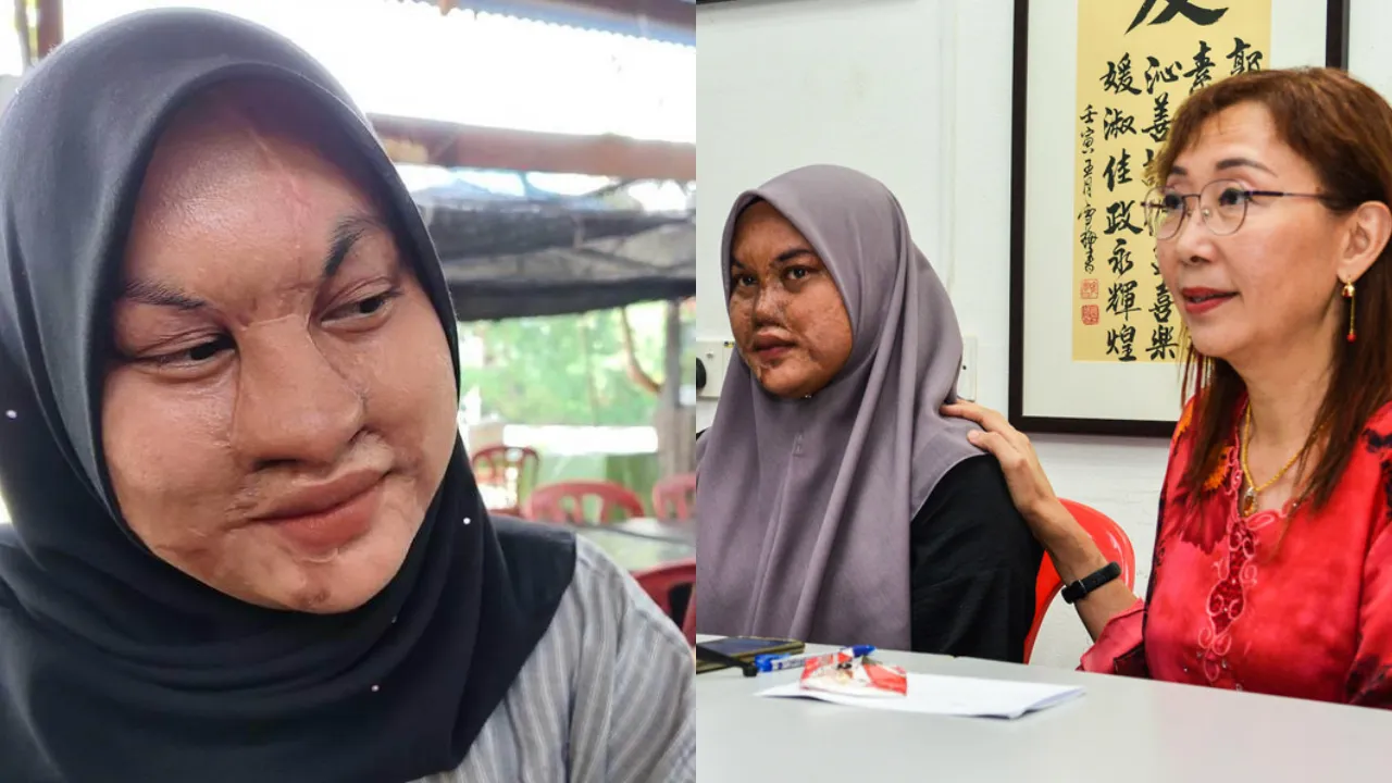 M'sian Woman Still Living With The Aftermath Of Her Father's Acid Attack 16 Years Later