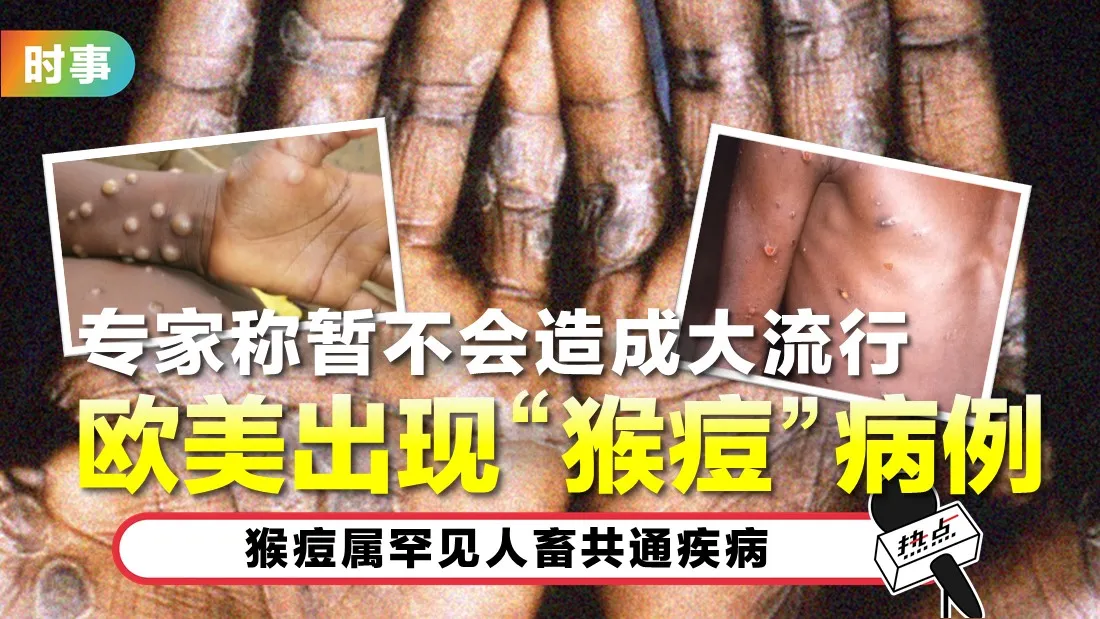 0519-monkeypox.jpg