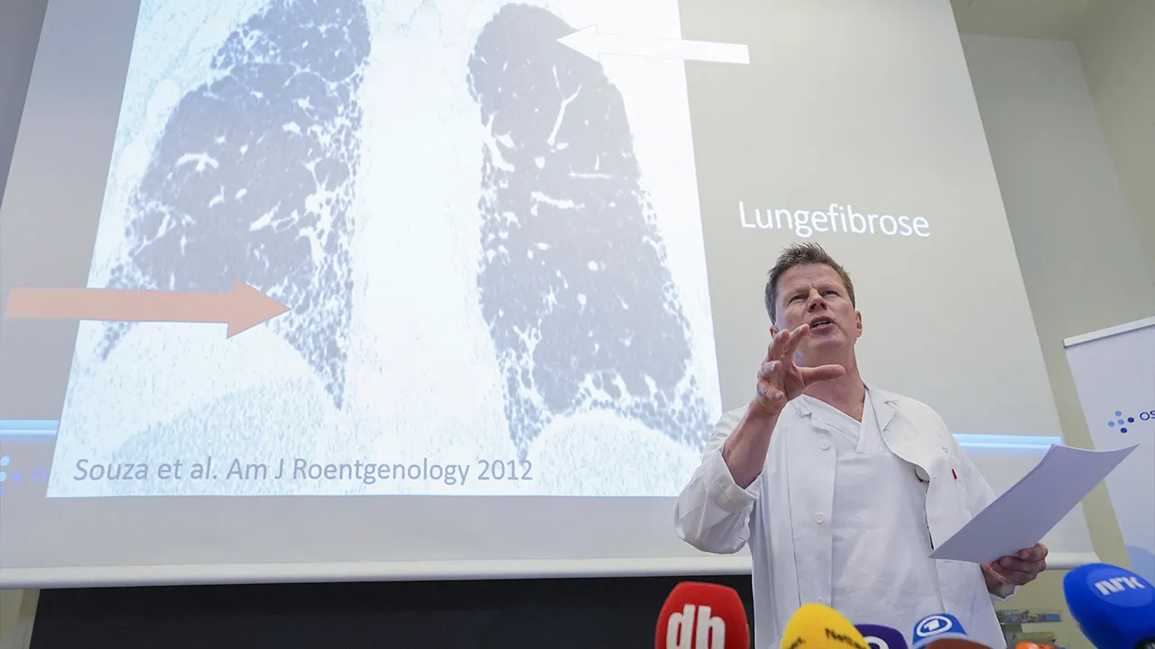 Chief physician and lung specialist Are Holm at Rikshospitalet speaks as he meets the press about Norway's Crown Princess Mette-Marit being put on the list for lung transplantation, in Oslo, Norway June 5, 2026. Lise Aserud/NTB/via REUTERS 