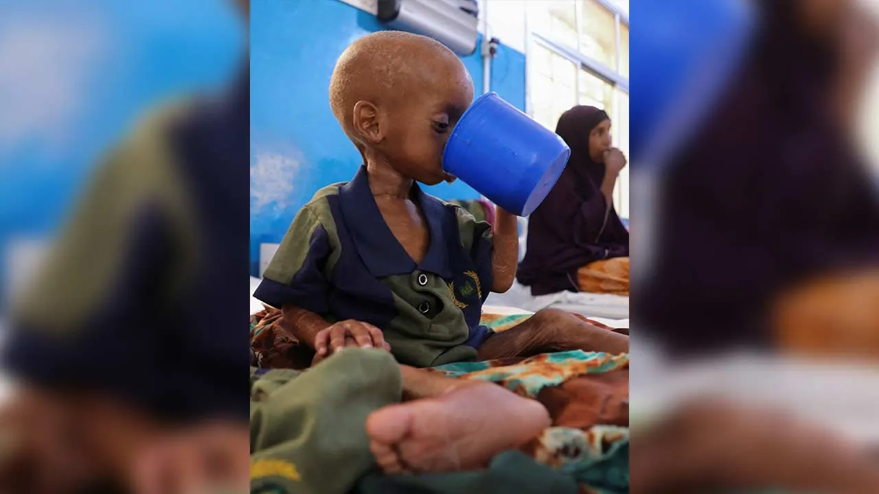 Bishar Salaad, a malnourished Somali child, drinks milk inside the pediatric ward of the Bay Regional Hospital where admissions for severe malnutrition have surged, and humanitarian funding continues to decline despite rapidly increasing needs according to Medecins Sans Frontieres (MSF), in Baidoa, Somalia August 10, 2026. REUTERS/Feisal Omar