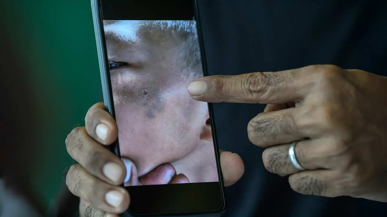 ALOR SETAR, 10 Ogos -- Bapa mangsa buli, Syamsul Azrin Man,45, menunjukkan kesan lebam pada bahagian muka anak lelakinya yang berusia sembilan tahun menjadi mangsa buli pelajar senior berusia 15 tahun di sekolahnya.  Beliau berkata dia hanya mengetahui kejadian yang menimpa anak tunggalnya itu ketika mengambilnya untuk pulang bercuti dari sebuah asrama maahad tahfiz, di sini pada 30 Julai lalu.  --fotoBERNAMA (2026) HAK CIPTA TERPELIHARA