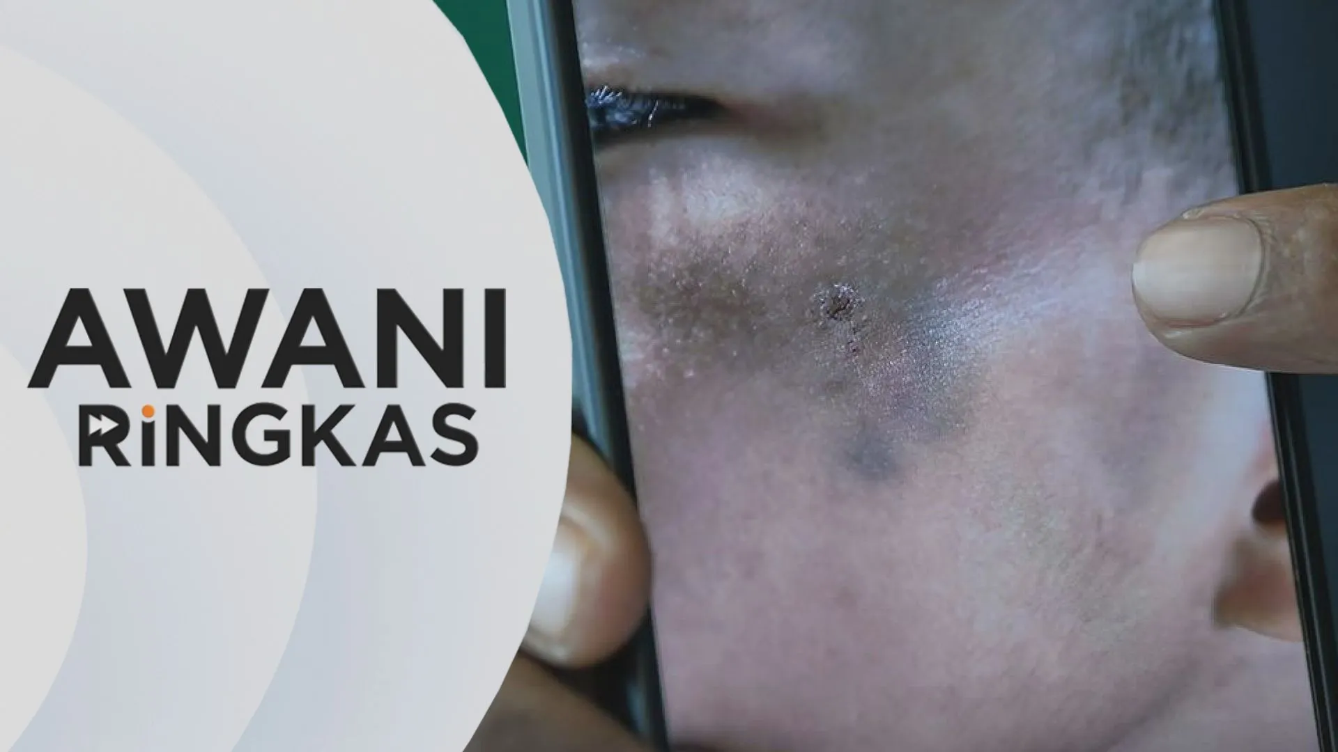 AWANI Ringkas: Suami isteri dakwa anak jadi mangsa buli pelajar senior